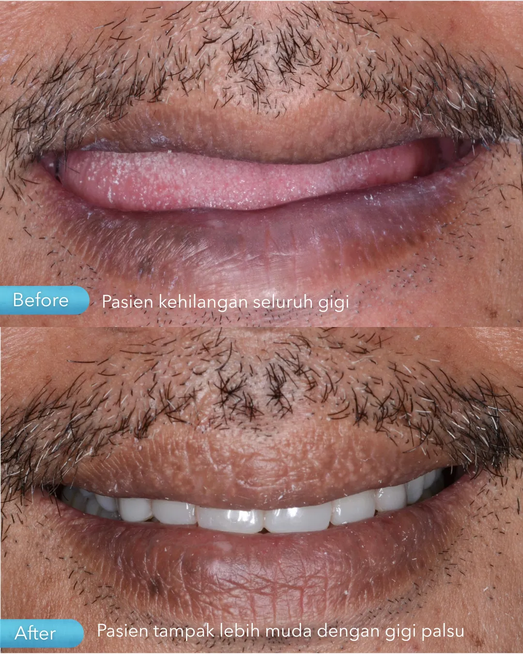Gigi palsu result